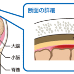 くも膜下出血とは? 病気の症状や治療方法、予防するには?