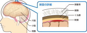 くも膜下出血とは？　病気の症状や治療方法、予防するには？