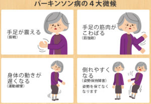 パーキンソン病関連疾患　症状や原因、治療方法は？