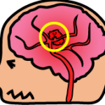 脳内出血とは？　後遺症は？　病気の症状や治療方法、予防するには？　