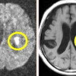 脳梗塞(のうこうそく)とは？　症状や治療、リハビリ方法、予防するには？