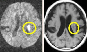 脳梗塞(のうこうそく)とは？　症状や治療、リハビリ方法、予防するには？