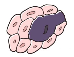 悪性腫瘍（ガン・癌）の基礎知識