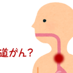 食道ガンとは？　症状や原因、治療方法は？
