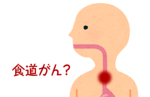 食道ガンとは？　症状や原因、治療方法は？