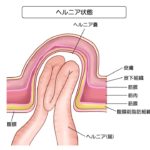 ヘルニア(鼠径ヘルニア)とは? 主な症状や原因、治療方法は?