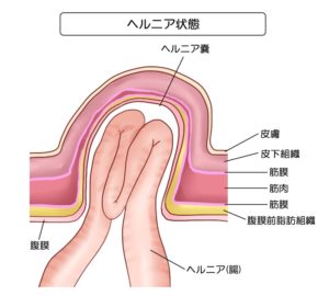 ヘルニア（鼠径ヘルニア）とは？　主な症状や原因、治療方法は？