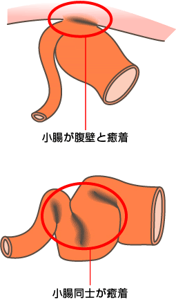 腸閉塞（イレウス）とは？ 主な症状や原因、治療方法は？