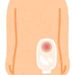 人工肛門（ストーマ）とは？　どのような患者が対象？注意点は？