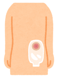 人工肛門（ストーマ）とは？　どのような患者が対象？注意点は？