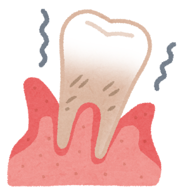 歯周病とは？　主な症状や原因、治療方法は？